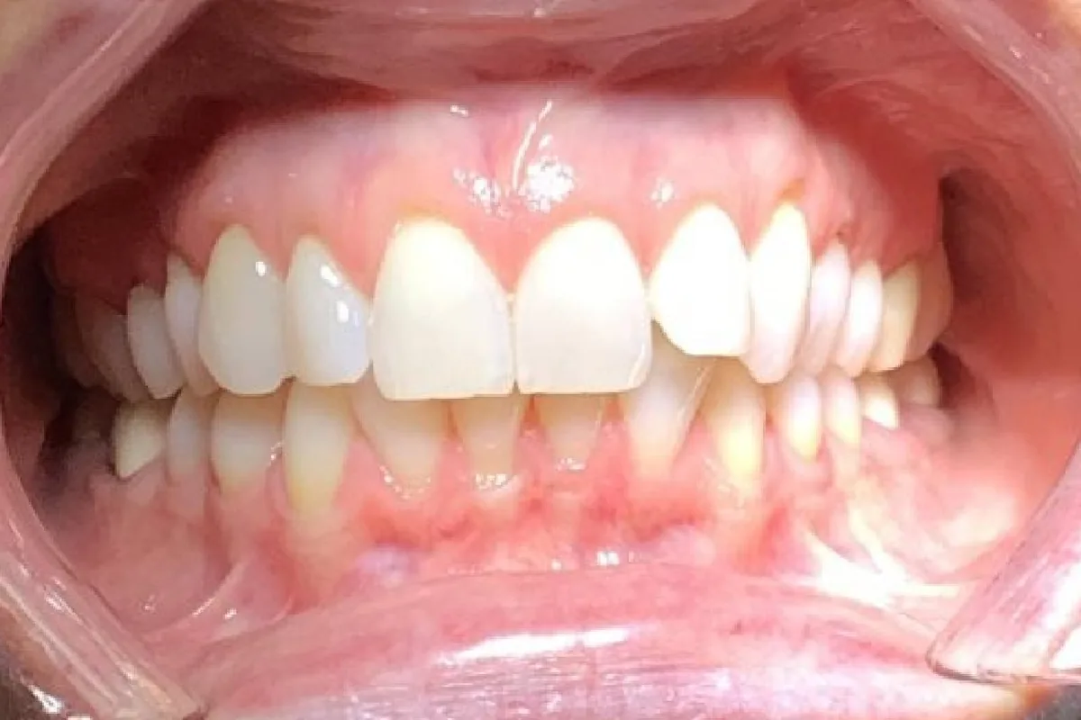Teeth before Invisalign treatment, case 2