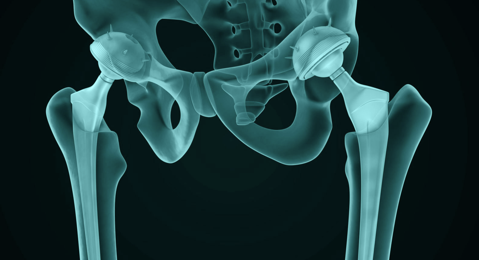Prótese total de quadril implantada