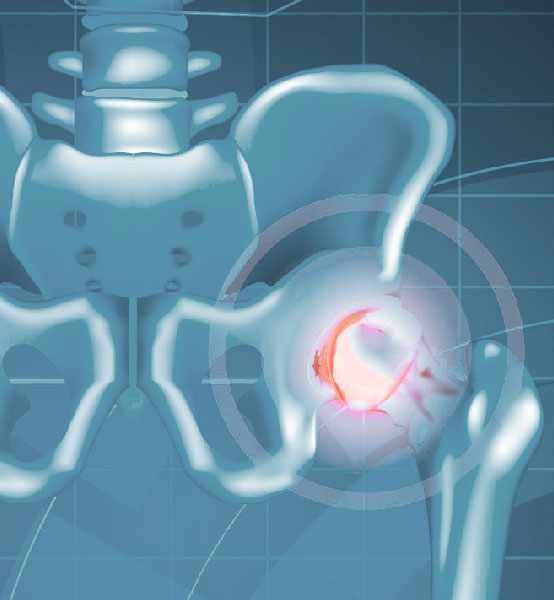 Necrose Avascular – ilustração do quadril