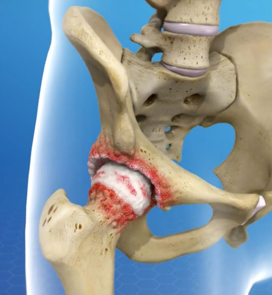 Osteoartrite – ilustração do quadril