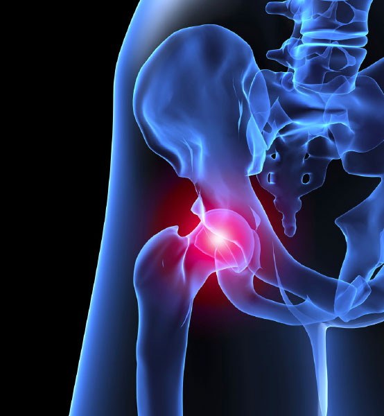 Ruptura de Labrum – ilustração do quadril