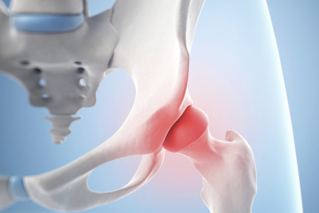 O que é Osteonecrose do Quadril?