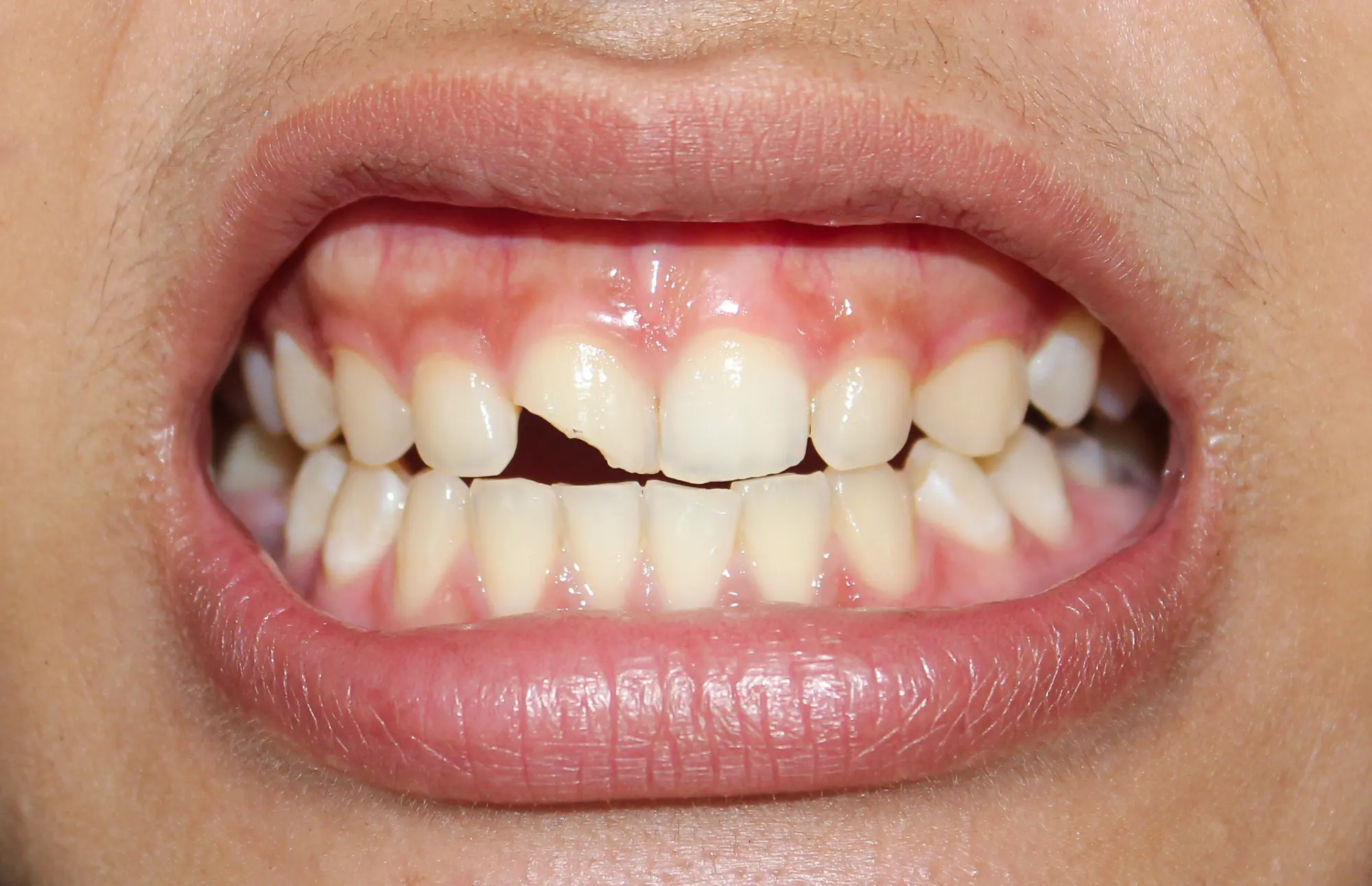 Can a Cracked Tooth Be Saved? Treatment Options for Apex Patients