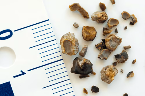 Examples of the size of kidney stones