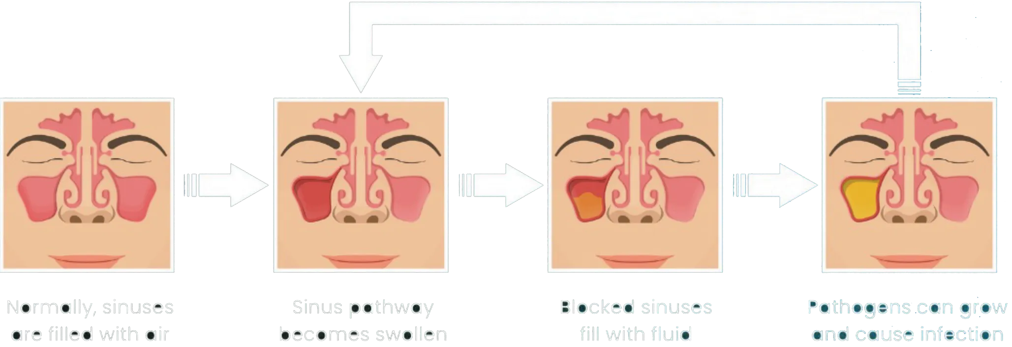 Four-step progression of sinus blockage, from normal air-filled sinuses to infection.