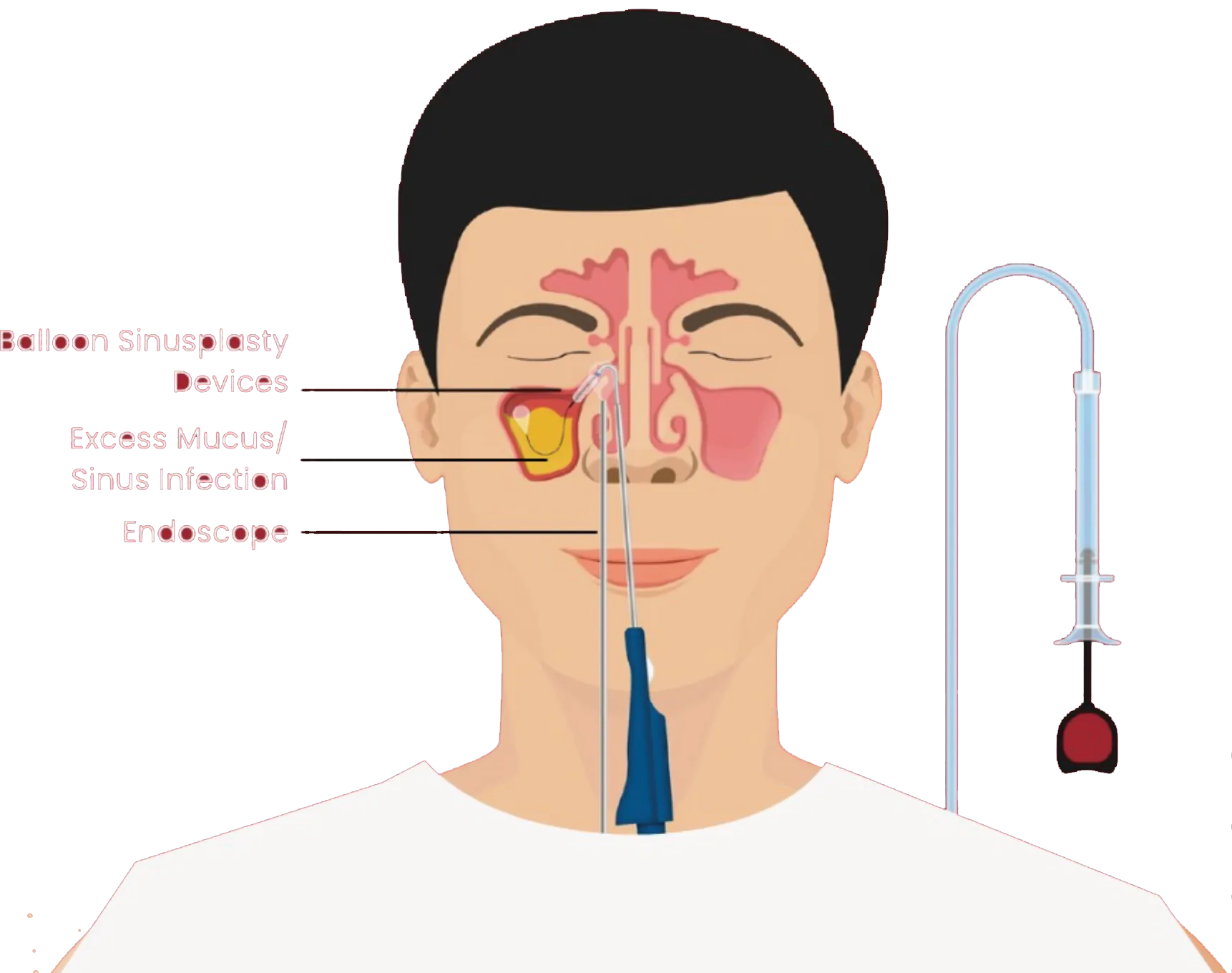 Illustration of balloon sinuplasty devices and an endoscope for treating sinus infections.