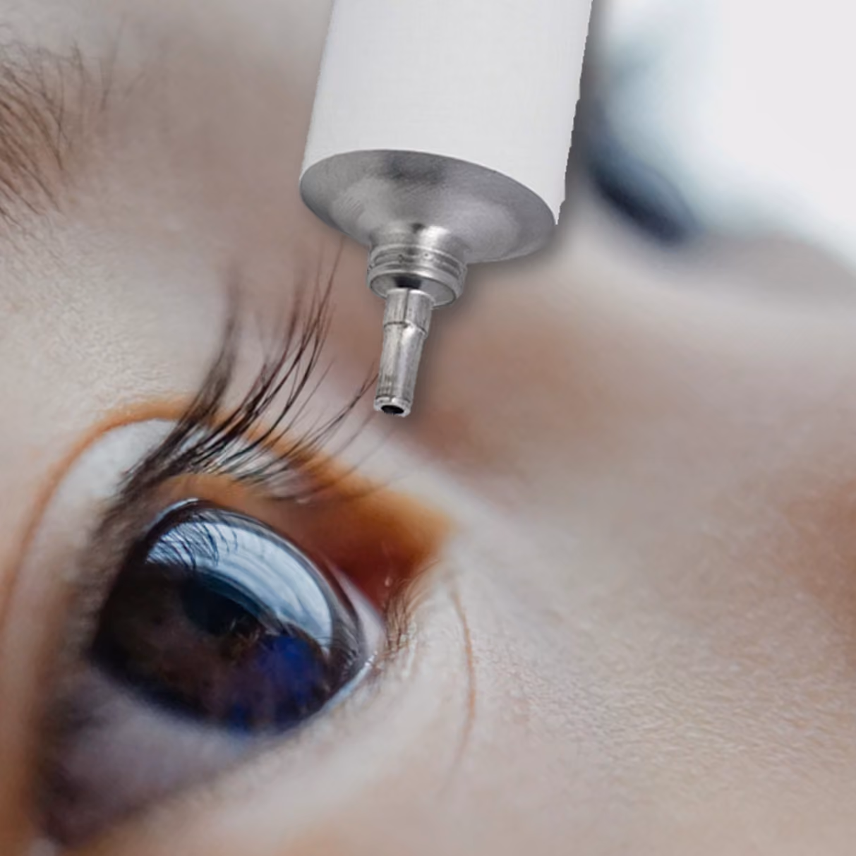 Um olho aberto com o tubo da pomada próximo, sem encostar - Aplicar a pomada sem deixar a ponta do tubo encostar nos olhos. (Fonte: Rede Olhos)