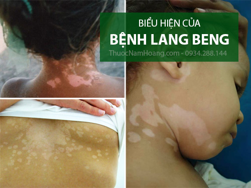 thuốc trị lang beng ở mặt