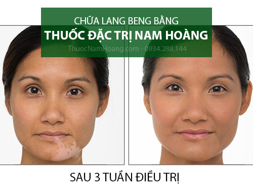 thuốc trị lang beng ở mặt