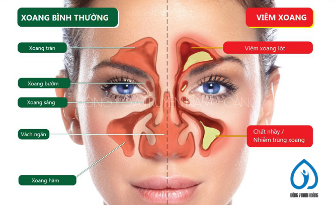 thuốc đông y trị viêm xoang viêm mũi dị ứng