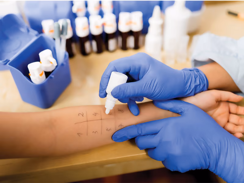 Physician administering an allergy test