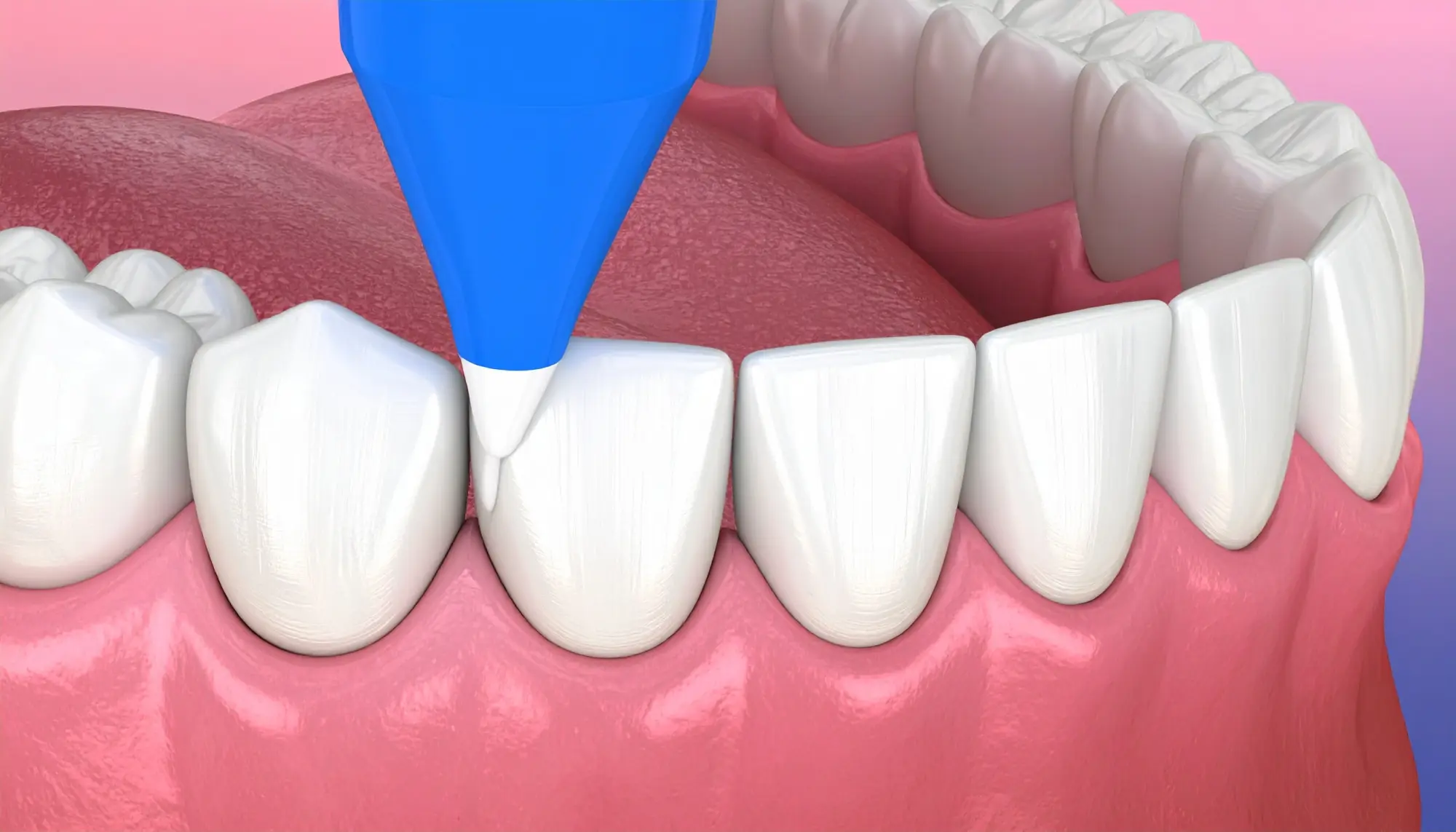Fixing Gaps and Chips: The Magic of Cosmetic Dental Bonding