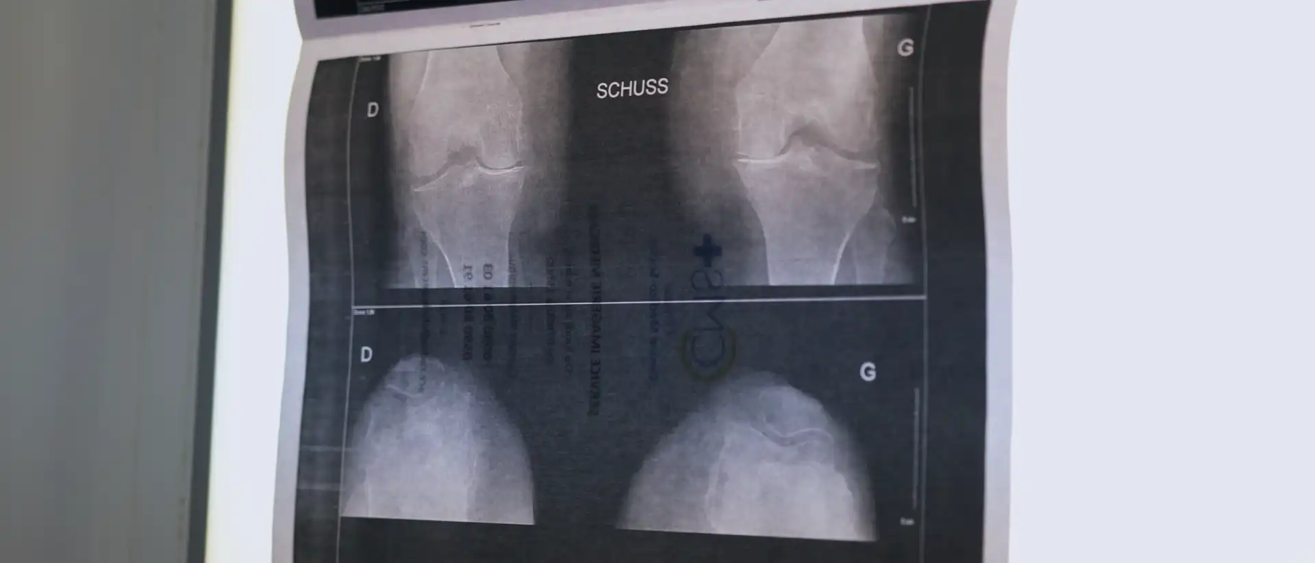 Prothèse totale de genou