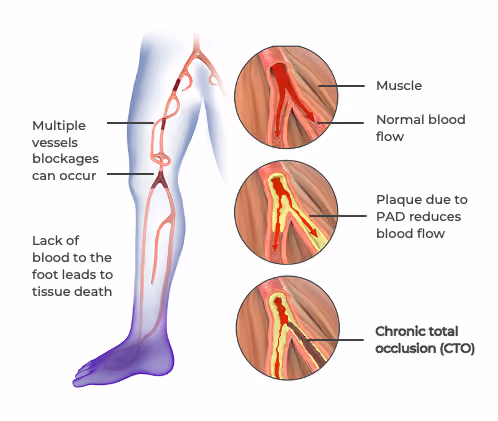 Diagram showing leg arteries with blockages, tissue death in foot, and stages of blood flow reduction by plaque in vessels.