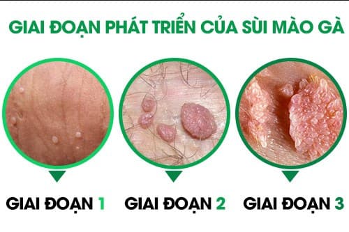 Bệnh Sùi mào gà