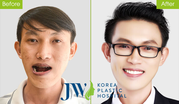Phẫu thuật hàm móm có nguy hiểm không, có đáng sợ không?