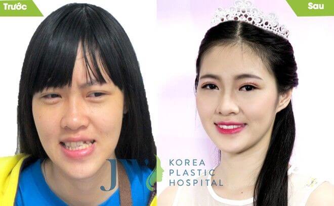 Phẫu thuật hàm móm có nguy hiểm không, có đáng sợ không?