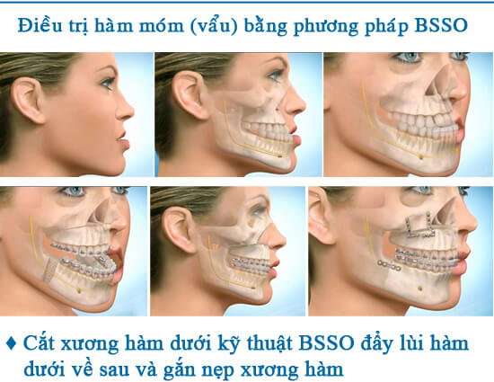 Móm xương hàm là gì? Có nên phẫu thuật hàm móm không?