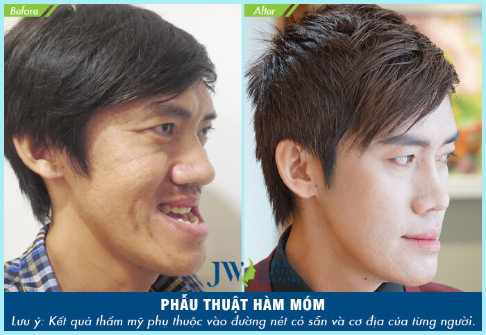 Móm xương hàm là gì? Có nên phẫu thuật hàm móm không?