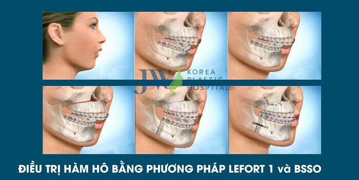 Phẫu thuật hàm hô móm là gì, có an toàn không, có vĩnh viễn không?