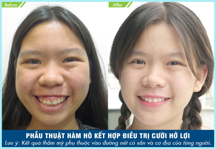 Phẫu thuật hàm hô móm là gì, có an toàn không, có vĩnh viễn không?