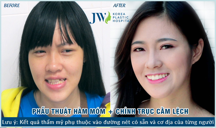 Cắt xương hàm chữa móm giá bao? 3 yếu tố quyết định chi phí phẫu thuật