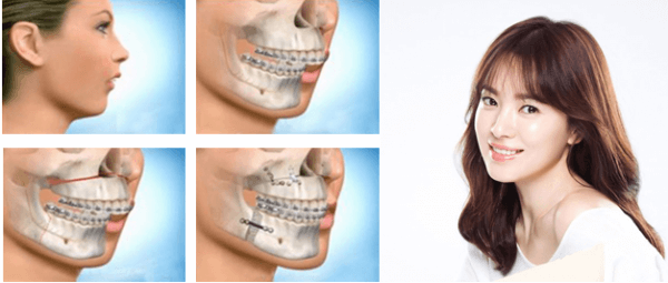 Phẫu thuật hàm hô không cần niềng răng như thế nào, đúng hay sai?