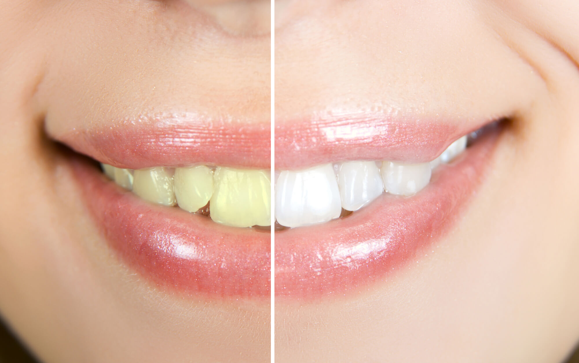 Cosmetic dentists in Marco Island teeth whitening