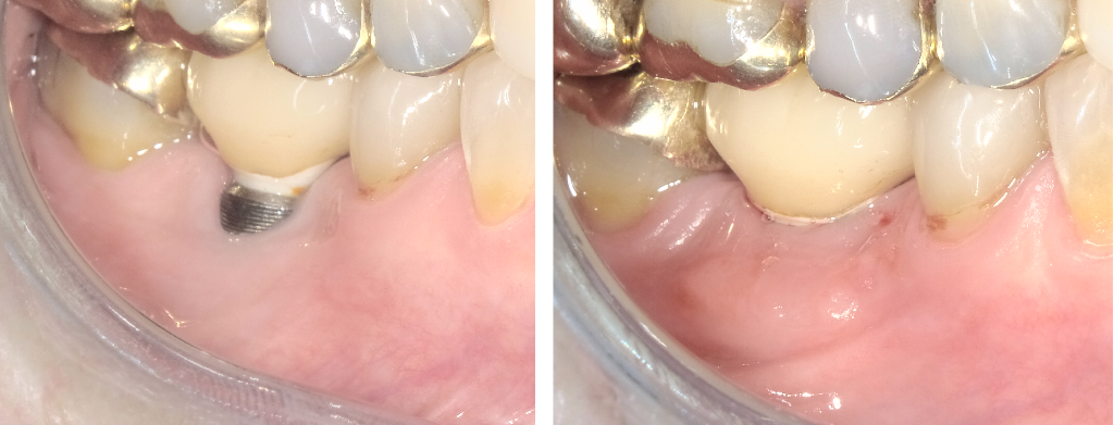before and after dental implants 