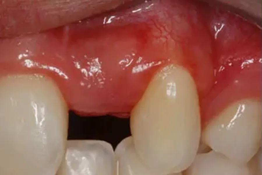 Before: missing front tooth and failing bridge site at Poulos, Somers & Marshall, Denver
