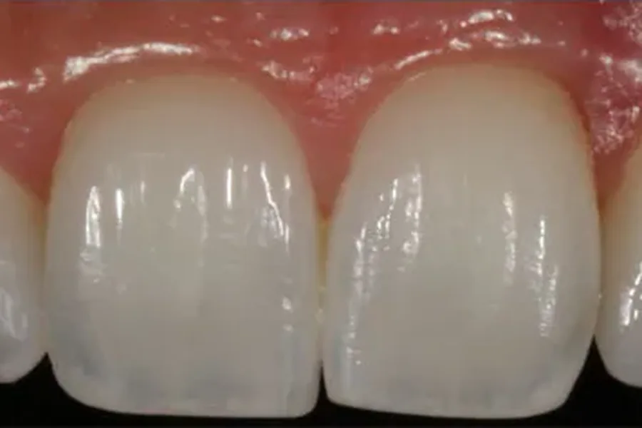 After: dental implant and bone graft restored with a natural-looking crown at Poulos, Somers & Marshall, Denver