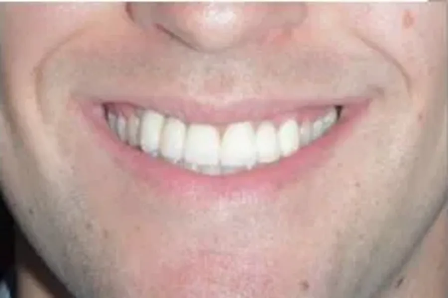 After: dental implant, soft tissue graft and two-tooth bridge restoring the smile at Poulos, Somers & Marshall, Denver