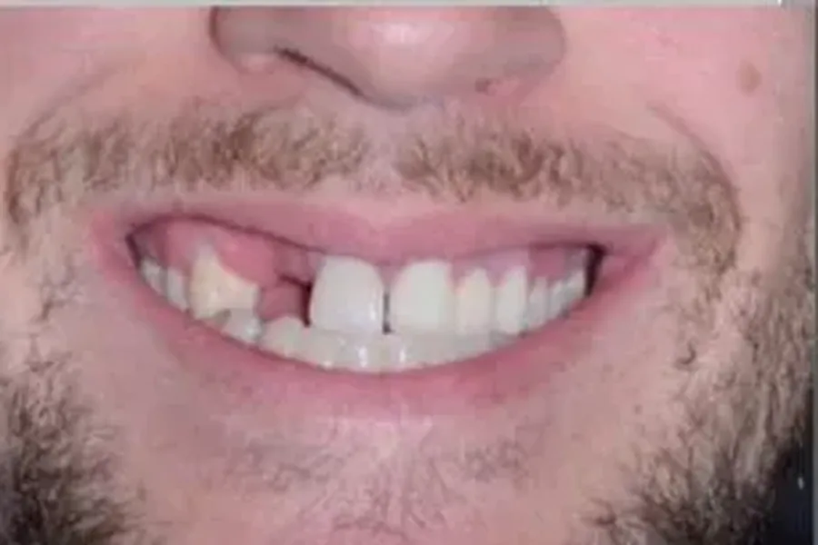 Before: smile with two teeth lost in an accident at Poulos, Somers & Marshall, Denver