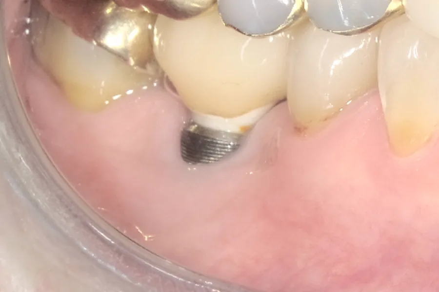 Before: receded gum exposing metal implant threads at Poulos, Somers & Marshall, Denver