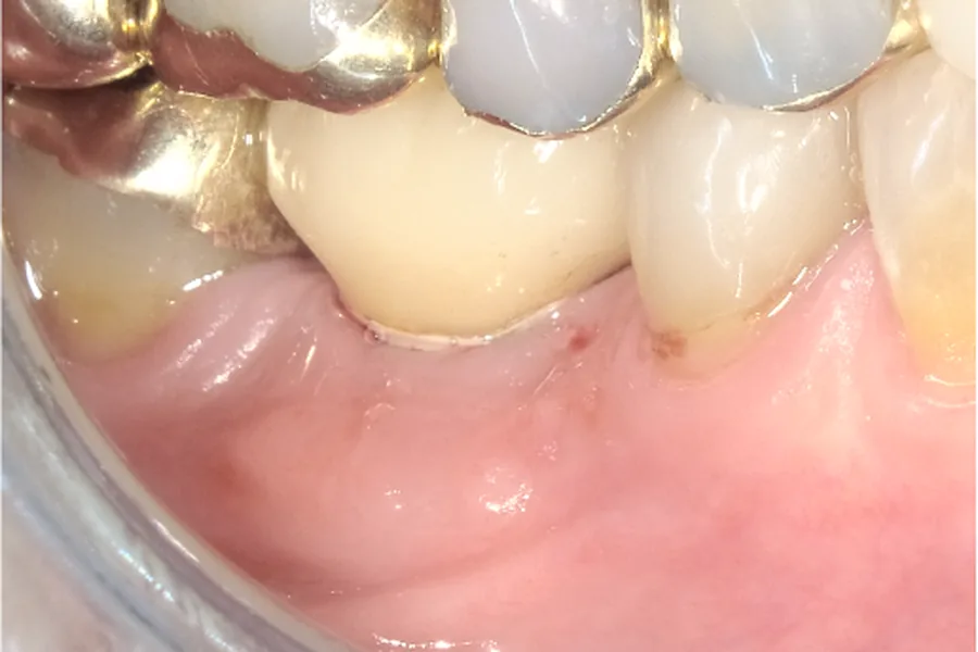After: gum graft covering the exposed implant threads at Poulos, Somers & Marshall, Denver