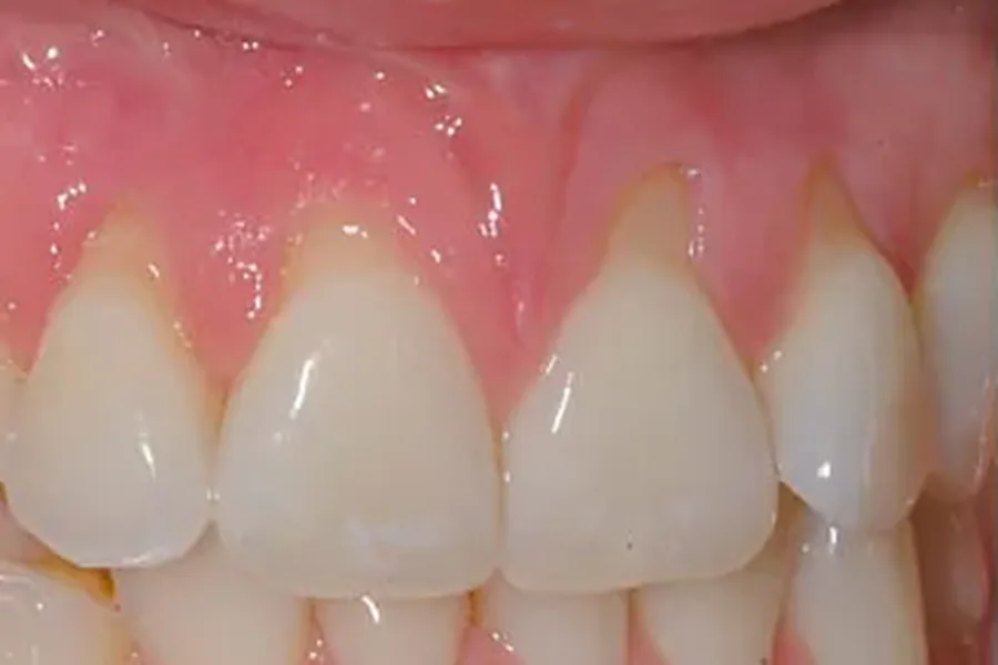 Before: receding gum line with exposed tooth roots at Poulos, Somers & Marshall, Denver