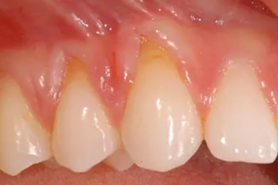Before: thin receding gums with exposed roots at Poulos, Somers & Marshall, Denver