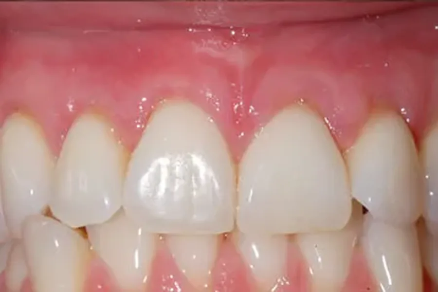 After: soft tissue graft restoring a healthy gum line at Poulos, Somers & Marshall, Denver