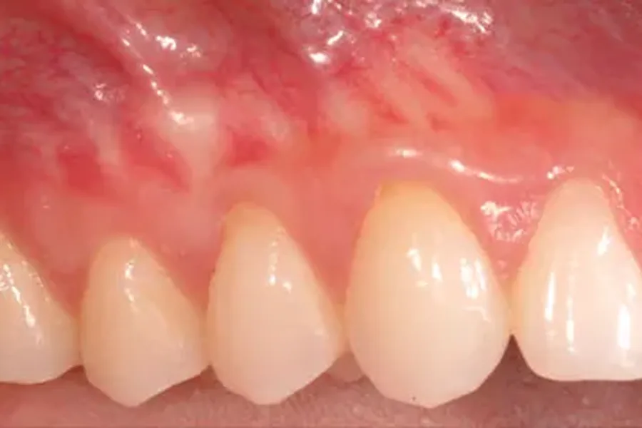 After: soft tissue grafting re-covering the exposed roots at Poulos, Somers & Marshall, Denver