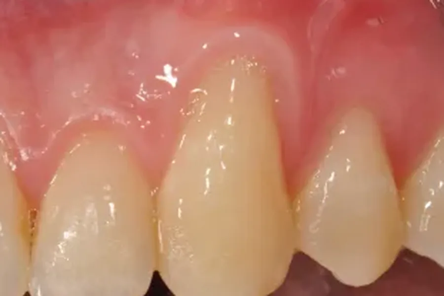 Before: uneven receding gum line across several teeth at Poulos, Somers & Marshall, Denver