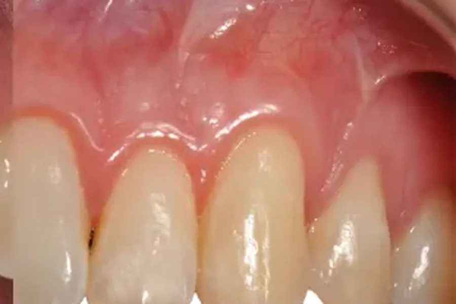 After: even, healthy gum contour following soft tissue grafting at Poulos, Somers & Marshall, Denver