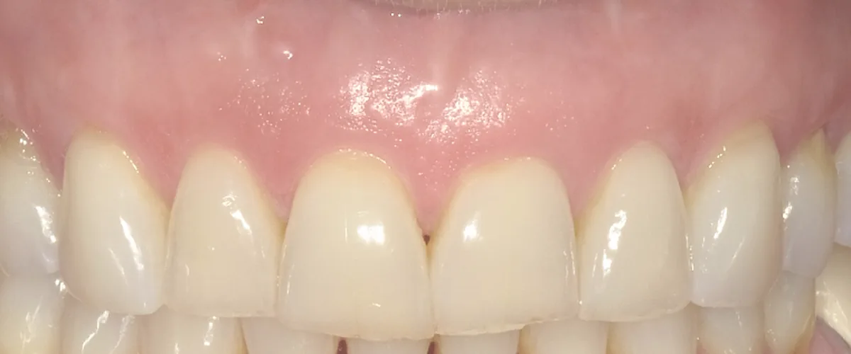 After: VISTA gum grafting with allograft covering the upper canine roots at Poulos, Somers & Marshall, Denver