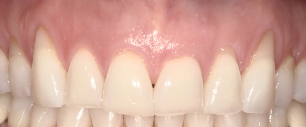 Before: gum recession around the upper canines at Poulos, Somers & Marshall, Denver