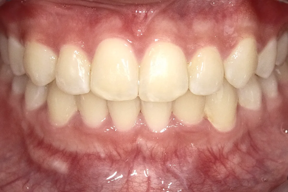 After: healthy thicker gums and aligned smile two years after POPA and orthodontics at Poulos, Somers & Marshall, Denver