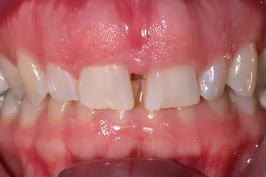 Before: gummy smile with excess gum tissue and a gap between the front teeth at Poulos, Somers & Marshall, Denver