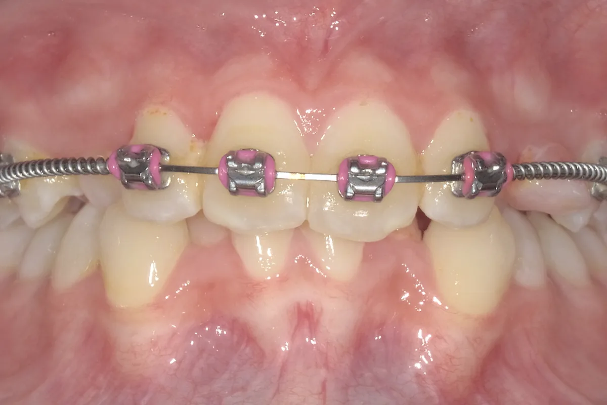 Before: thin gums and bone around the lower teeth with braces, at consultation, at Poulos, Somers & Marshall, Denver