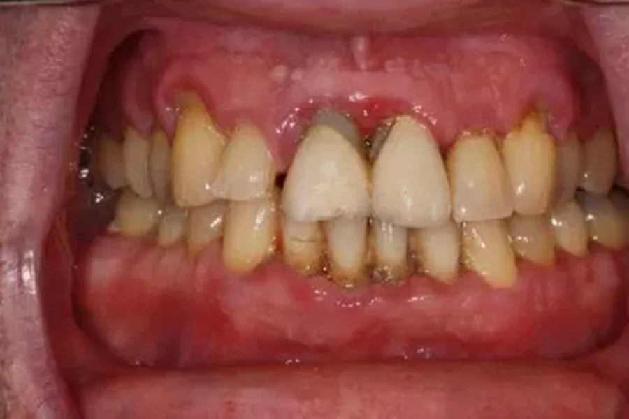 Before: severe periodontal disease with inflamed gums and loose teeth at Poulos, Somers & Marshall, Denver