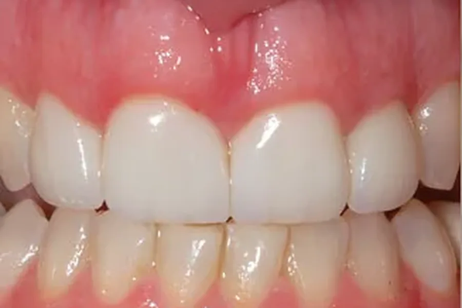 After: esthetic crown lengthening and veneers creating a balanced smile at Poulos, Somers & Marshall, Denver