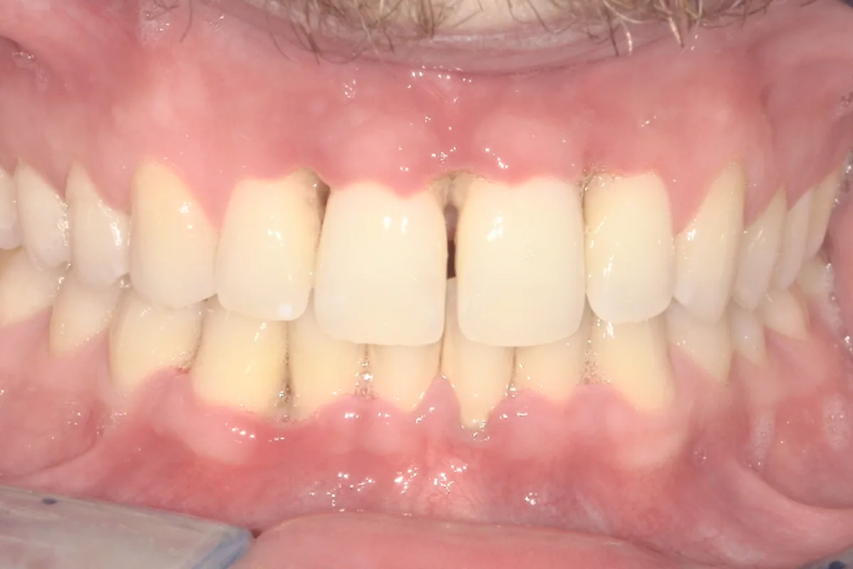 Before: painful, inflamed gums from periodontal disease at Poulos, Somers & Marshall, Denver