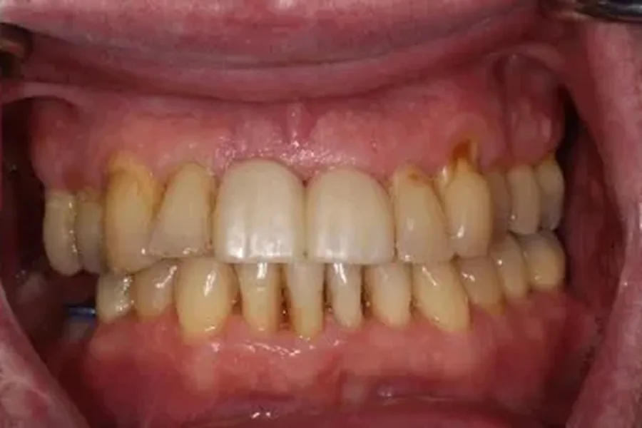 After: natural teeth preserved with LANAP laser therapy and healthy gums at Poulos, Somers & Marshall, Denver